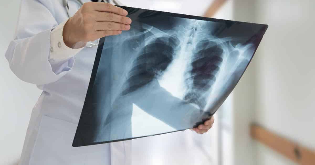 Radiografía de Tórax en Bogotá